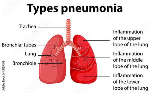 Diagram showing types pneumonia