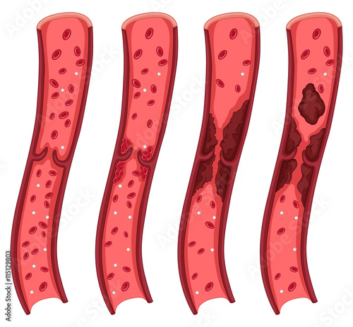 Blood clot diagram on white