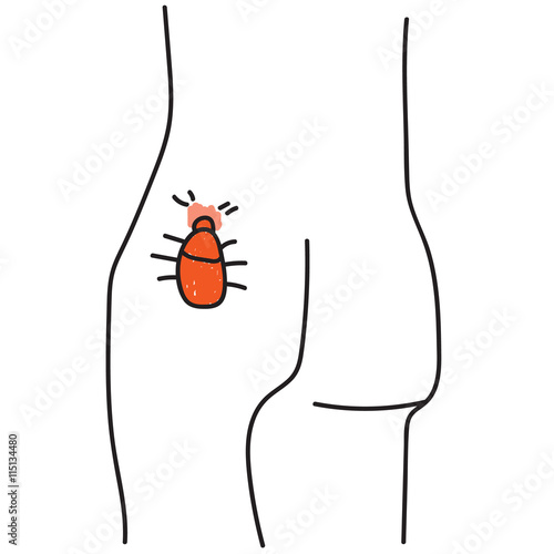 Tick biting on human skin hand drawn