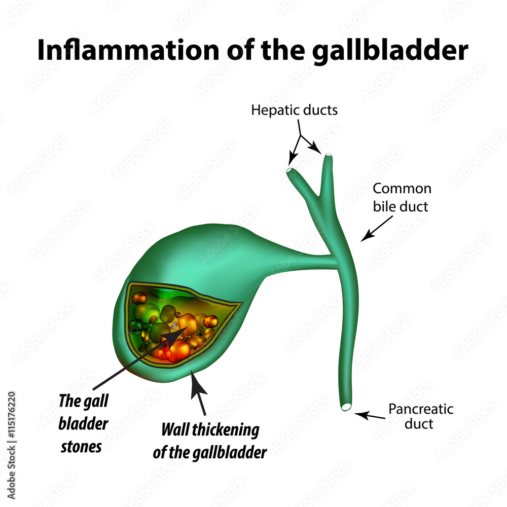Gallstones. Cholelithiasis. Cholecystitis. Inflammation of the