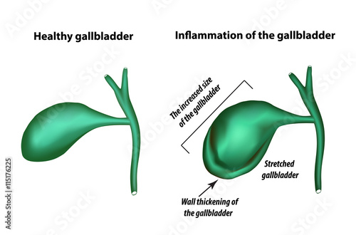 Symptoms of gallbladder inflammation. Cholecystitis. Thickening of the gallbladder wall. Increased gall bladder. Infographics. Vector illustration on isolated background