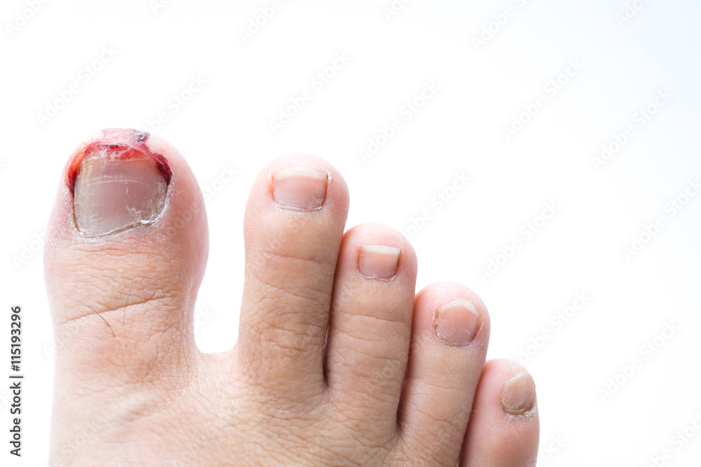 Bleeding from toenail Bleeding from toenail