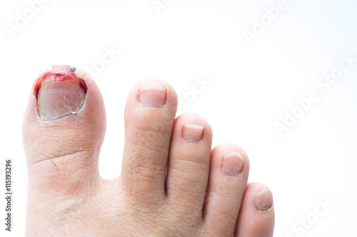 Bleeding from toenail