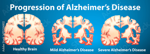 Progression of Alzheimer's disease on blue background