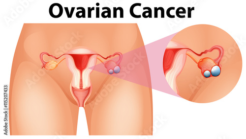 Diagram showing ovarian cancer
