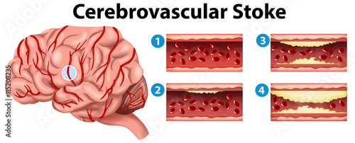 Diagram showing stages of cerebrovascular stroke