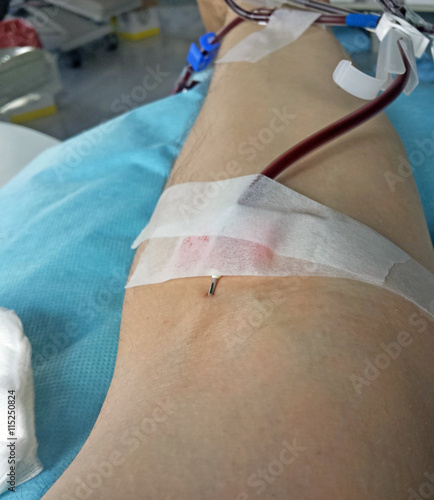 blood transfusion at the hospital photo