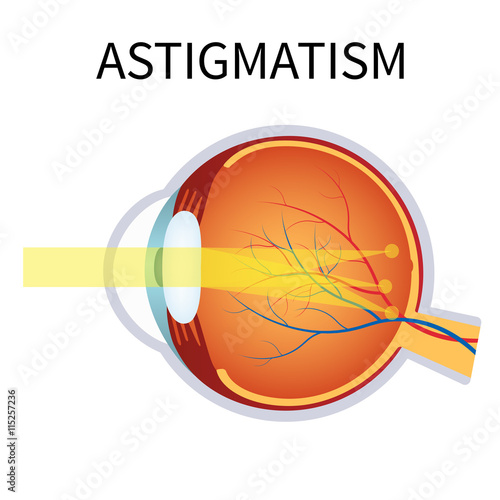 Astigmatism. Eyesight problem, blurred vision.