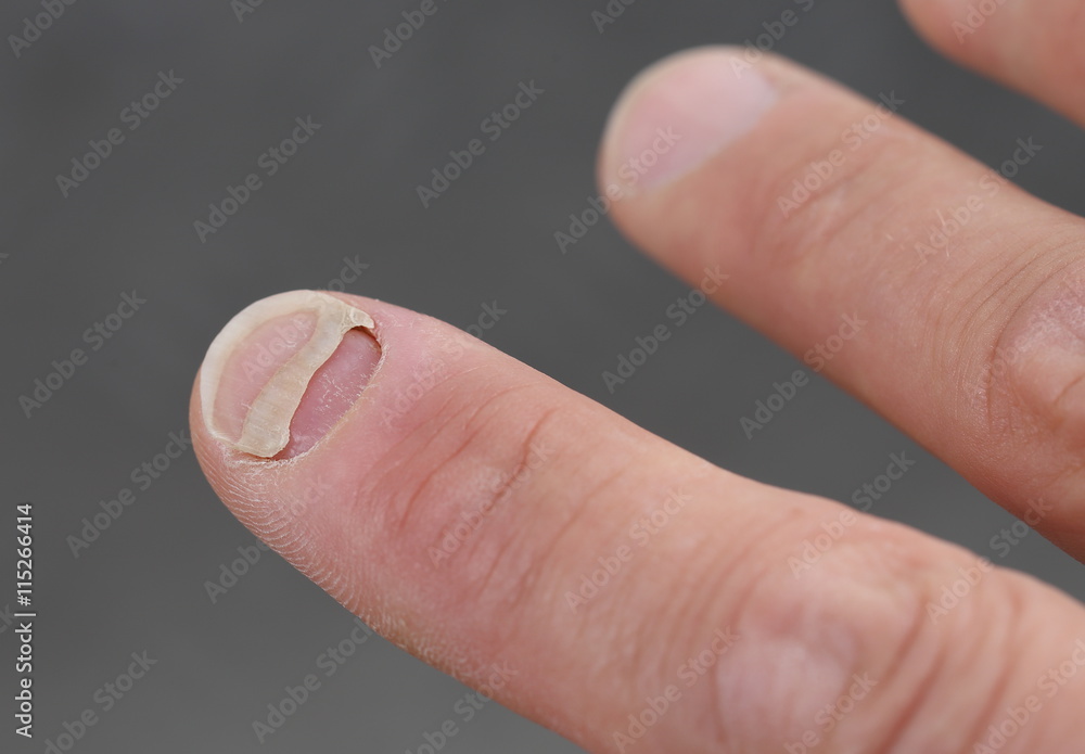 Ablösender Fingernagel Ablösender Fingernagel