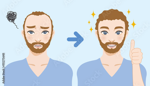 men's thinning hair treatment before after image illustration