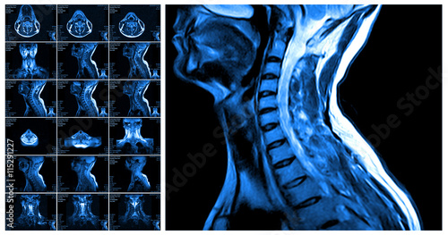 Magnetic resonance imaging of the cervical spine.