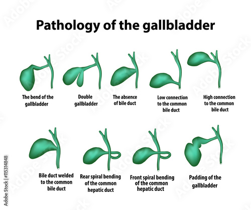 Pathology of the gallbladder. The bend of the gallbladder. Set. Vector illustration on isolated background