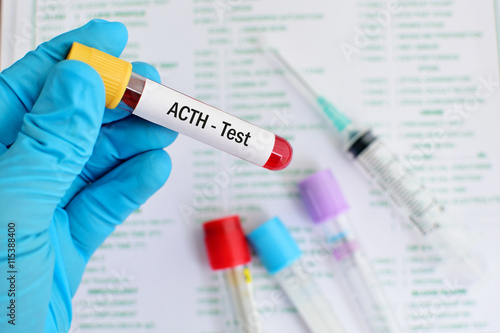 Blood sample for adrenocorticotropic hormone (ACTH) test
 photo