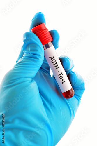 Blood sample for adrenocorticotropic hormone (ACTH) test
 photo