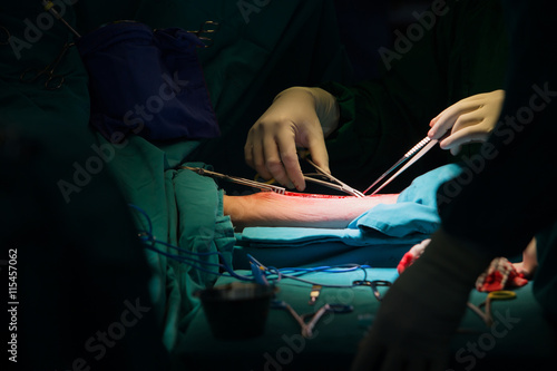 Surgery for Coronary Artery Bypass Grafting: CABG