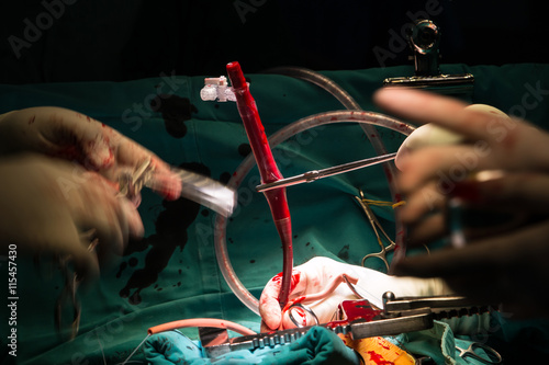coronary artery bypass grafting