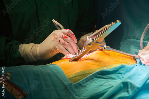 Surgery for Coronary Artery Bypass