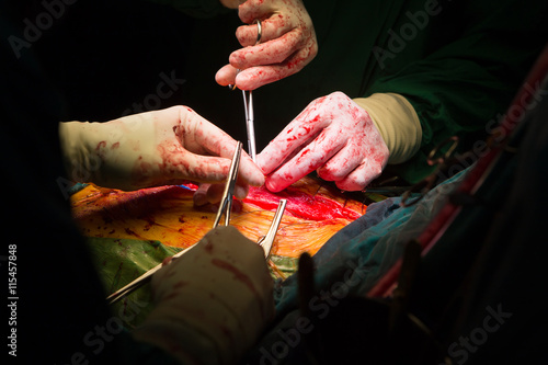 Photos closure sternum bone with metal wires