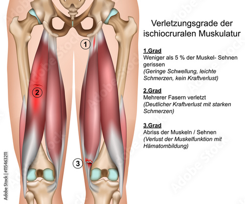Ischiocrurale Muskeln des Oberschenkels, hamstring muscles