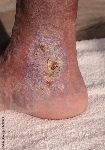 Medical picture: Infection cellulitis on the skin of an ankle caused by phlebitis and blood clots in the vein.  photo