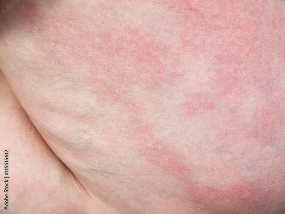Rashes on the skin texture Rashes on the skin texture
