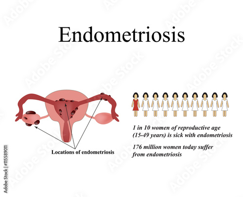 Endometriosis. Endometrial cysts. The endometrium. Statistics endometriosis. The structure of the pelvic organs. Infographics. Vector illustration on isolated background