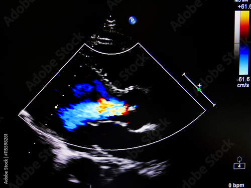 Flow color mode in echocardiogram