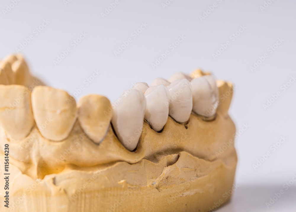 Fototapeta premium Dental prosthesis