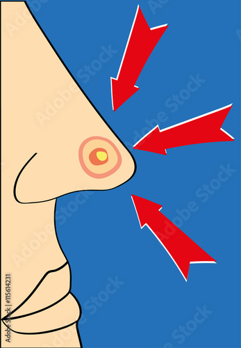 Close up of a nose with a large red spot or pimple with a white head and three red arrows pointing at it