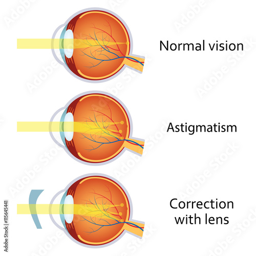Astigmatism corrected by a cylindrical lens.