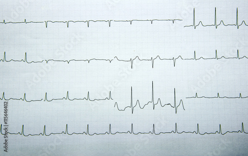 cardiogram. waveform from an EKG test.