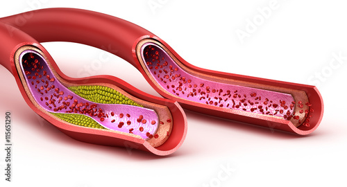 Blood vessel : normal and cholesterol damaged vessel . 3D render photo