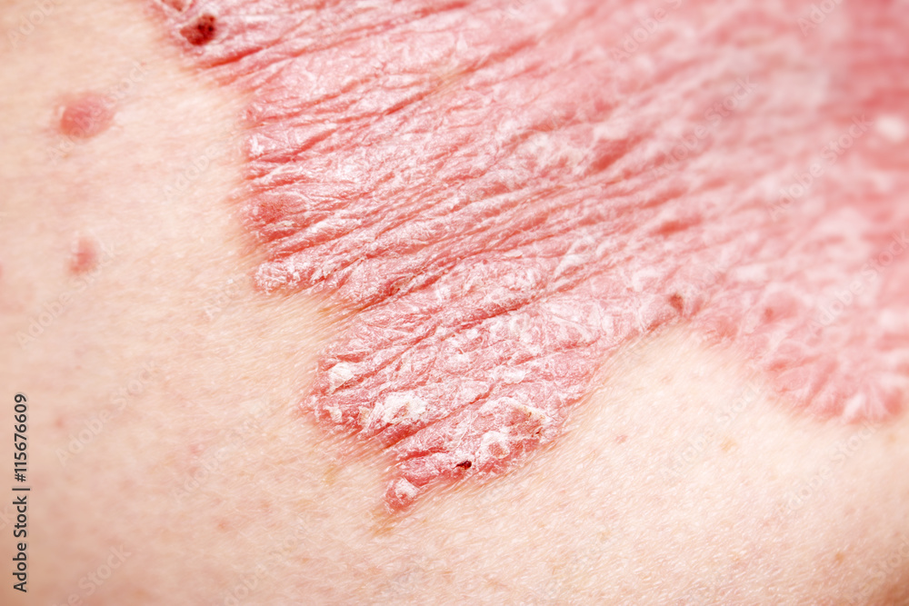 Fototapeta premium Psoriasis, psoriatic skin disease