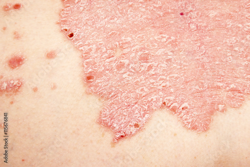 Psoriasis, psoriatic skin disease