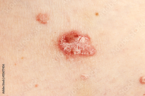 Psoriasis, psoriatic skin disease