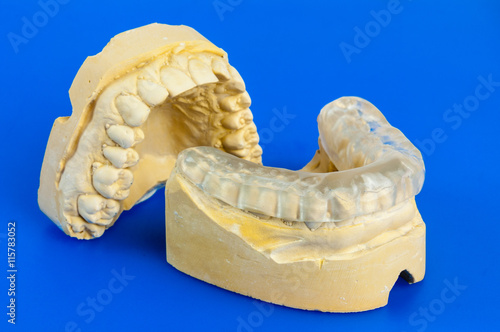 dental bite with chalk model