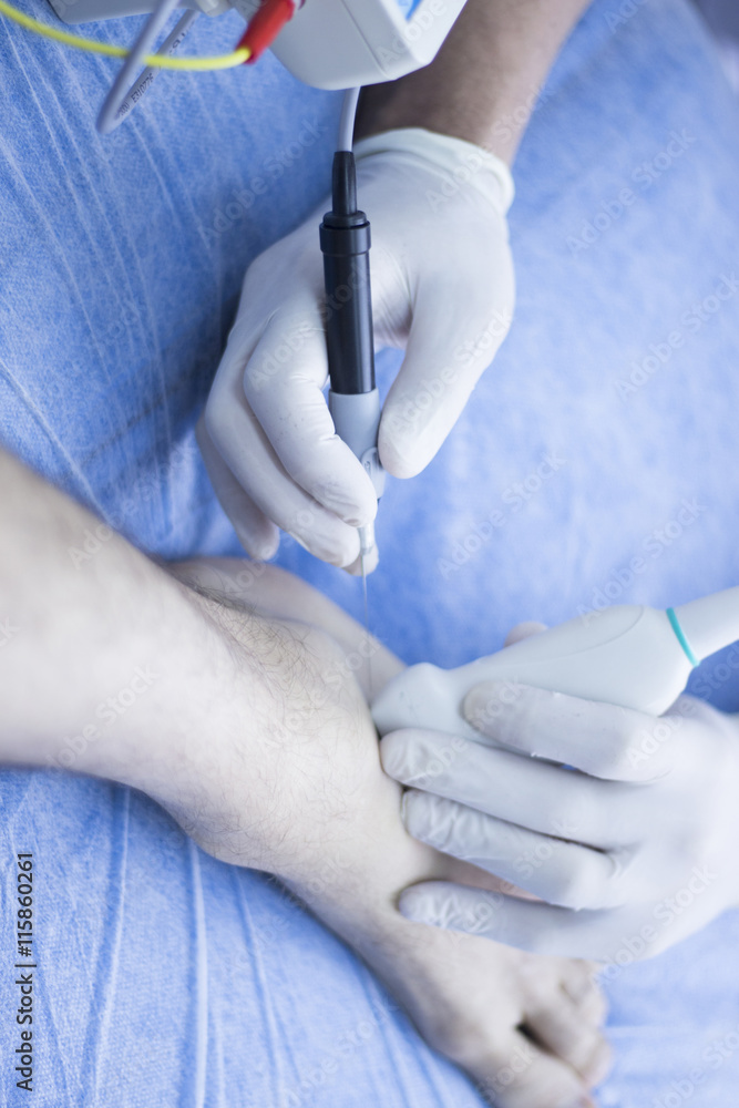Obraz premium Intratissue percutaneous electrolysis