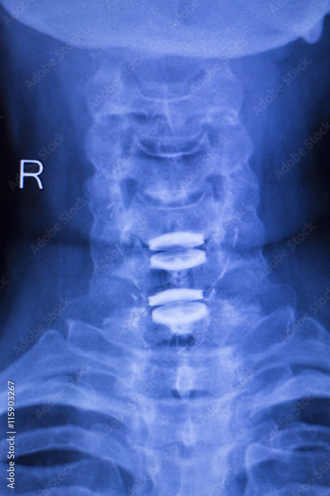 Neck and spine injury xray scan Neck and spine injury xray scan