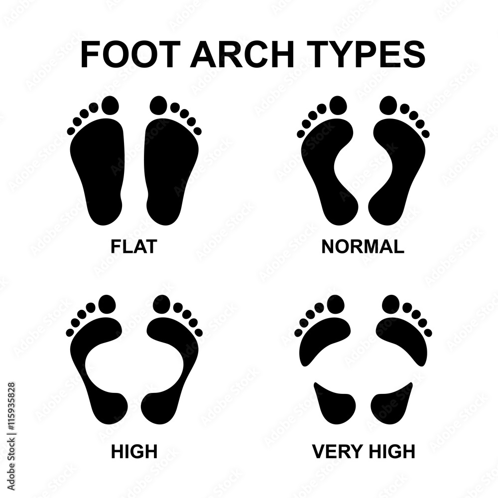 Set of flat foot, high arch Set of flat foot, high arch