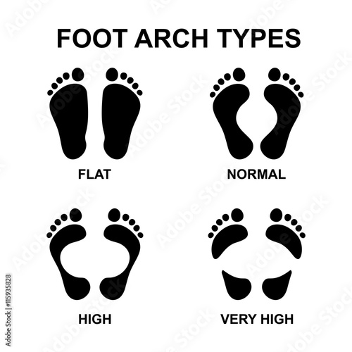 Set of flat foot, high arch