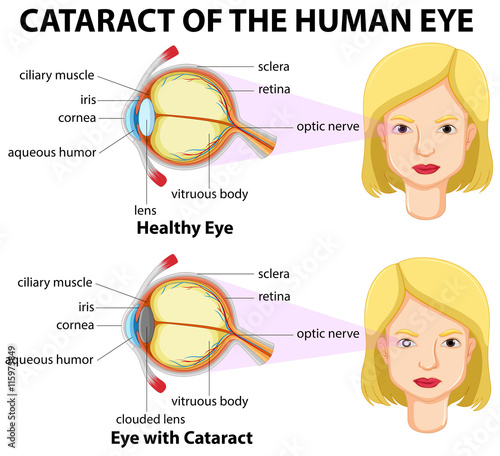 Diagram showing eyes with cataract