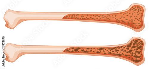 Osteoporosis in human bone