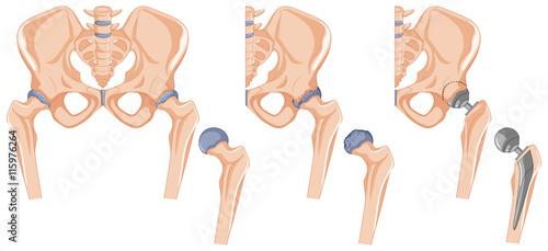 Diagram showing the hip bone treatment