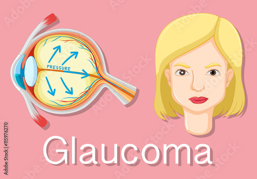 Diagram showing eyes with glaucoma