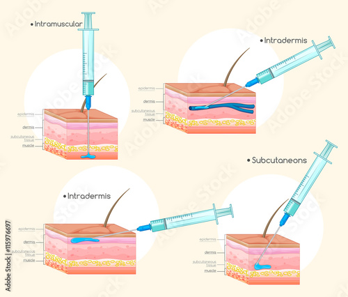 Different types of injections