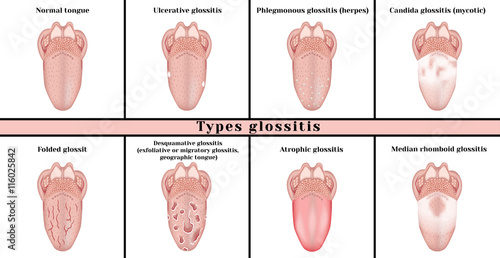 Types glossitis: candidiasis (mycotic), ulcerative, abscess (herpes), desquamative (exfoliative or migratory glossitis, geographic tongue), atrophic, median rhomboid glossitis, folded glossitis.