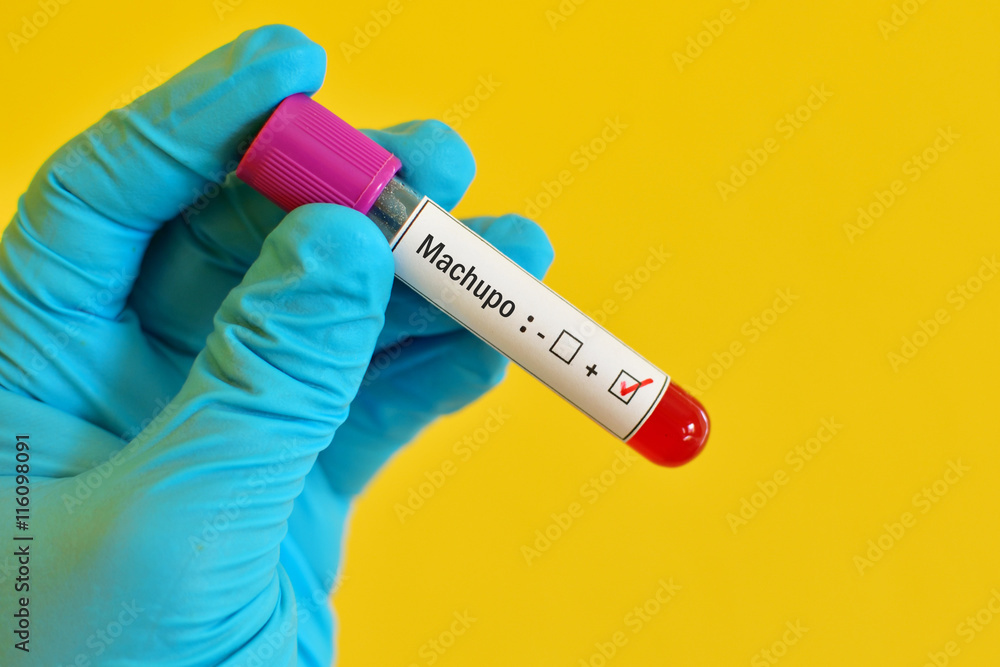 Obraz premium Machupo virus positive 