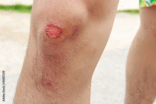 Bruise on right knee - Man knee pain