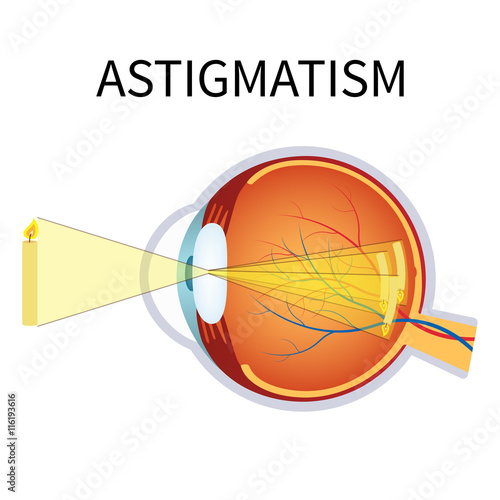 Illustration of astigmatism.
