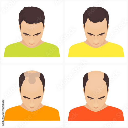 Different stages of hair loss in men. Hair care concept. Vector illustration.